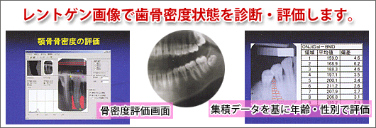 レントゲン画像で歯骨密度状態を診断・評価します 